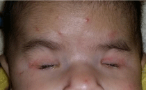 Bilateral Anophthalmia: Medical Advances And Future Hope For Affected Children Bilateral Anophthalmia: Medical Advances And Future Hope For Affected Children