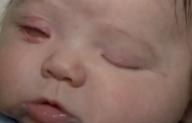 Bilateral Anophthalmia: Understanding The Rare Condition Of Babies Born Without Eyes Bilateral Anophthalmia: Understanding The Rare Condition Of Babies Born Without Eyes