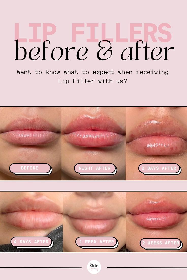 Daisy May Cooper's Weight Loss And Lip Filler Journey: An Honest Account Daisy May Cooper's Weight Loss And Lip Filler Journey: An Honest Account