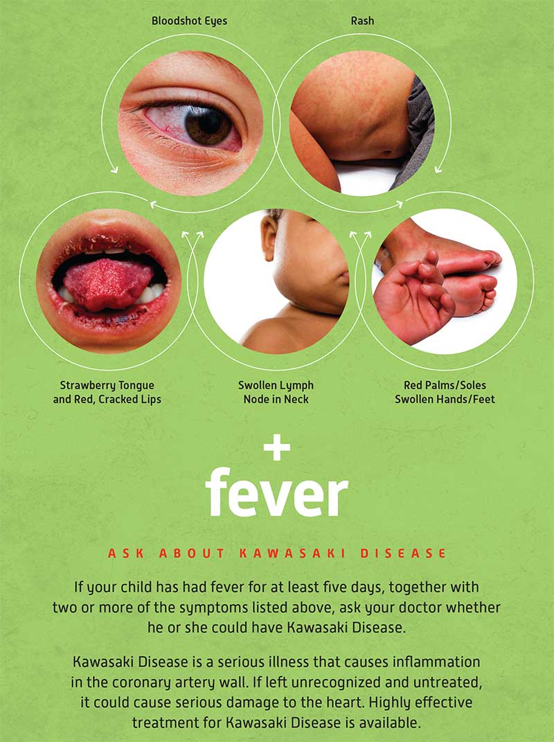 Is A Single, Unknown Respiratory Virus The Cause Of Kawasaki Disease? New Data Suggests A Link Is A Single, Unknown Respiratory Virus The Cause Of Kawasaki Disease? New Data Suggests A Link