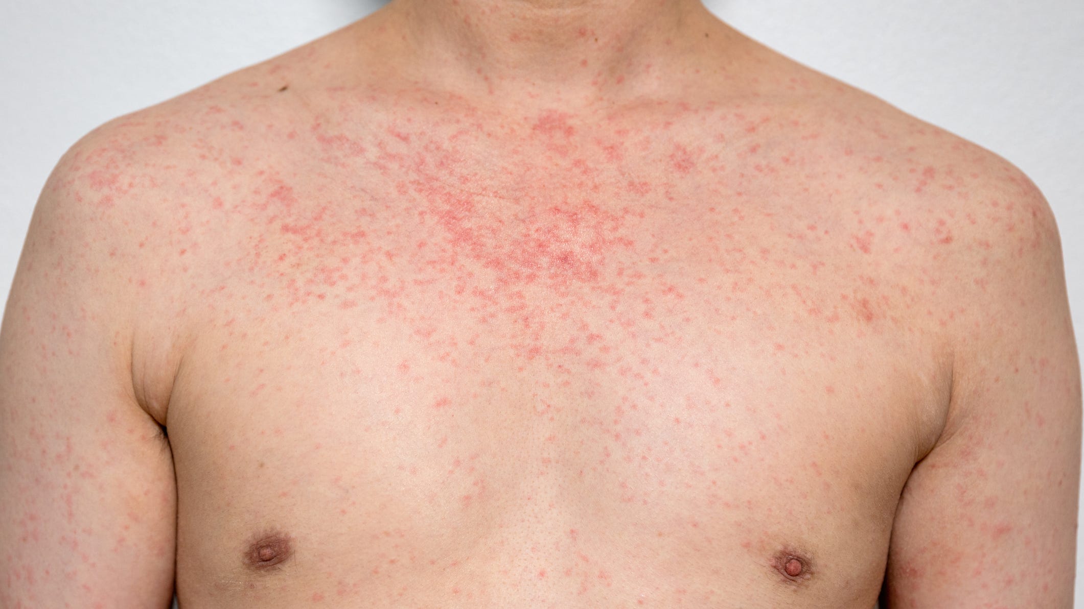 Measles Outbreak In North Dakota: Schoolchildren Quarantined Measles Outbreak In North Dakota: Schoolchildren Quarantined
