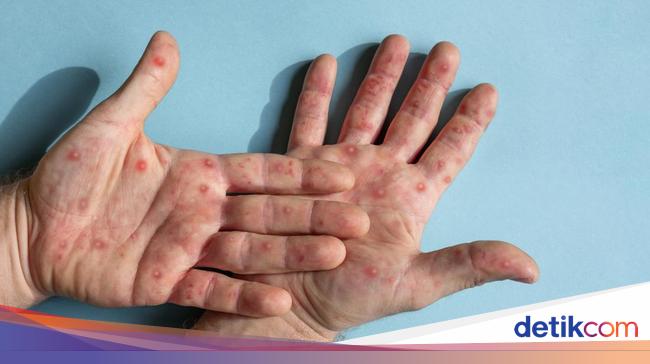 Meningkatnya Kasus Suspek Campak Di Pohuwato: Peran Imunisasi Anak Meningkatnya Kasus Suspek Campak Di Pohuwato: Peran Imunisasi Anak