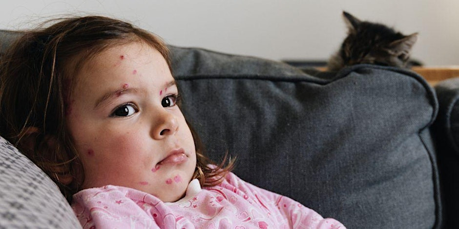 Texas Facing Increase In Unrelated Measles Cases Texas Facing Increase In Unrelated Measles Cases