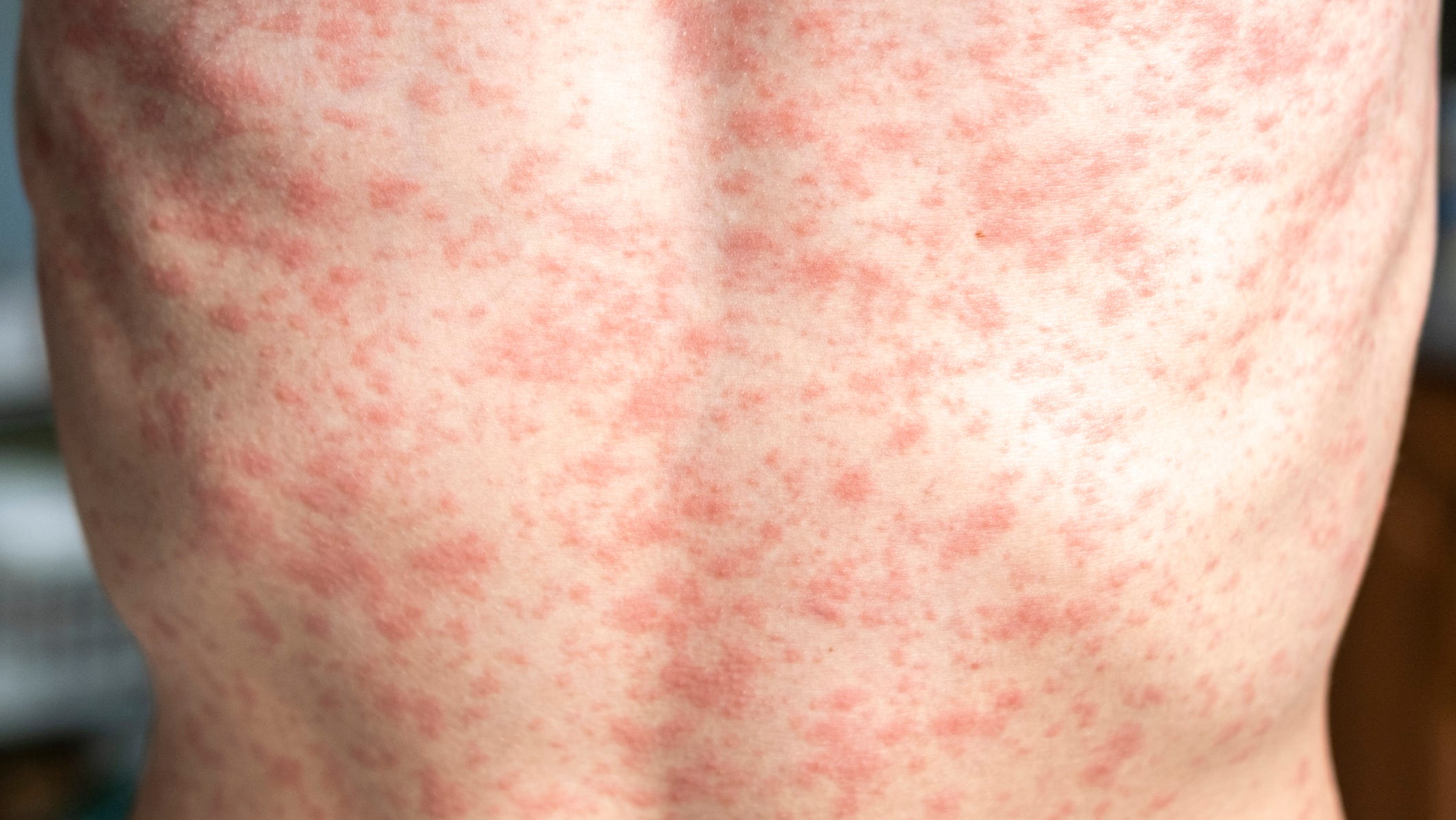 Texas Measles Outbreak: Unlinked Cases Surge Statewide Texas Measles Outbreak: Unlinked Cases Surge Statewide